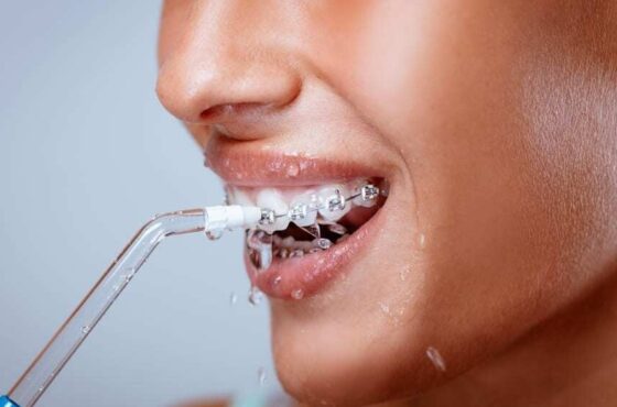 Tips chọn tăm nước để chăm sóc răng khi niềng răng